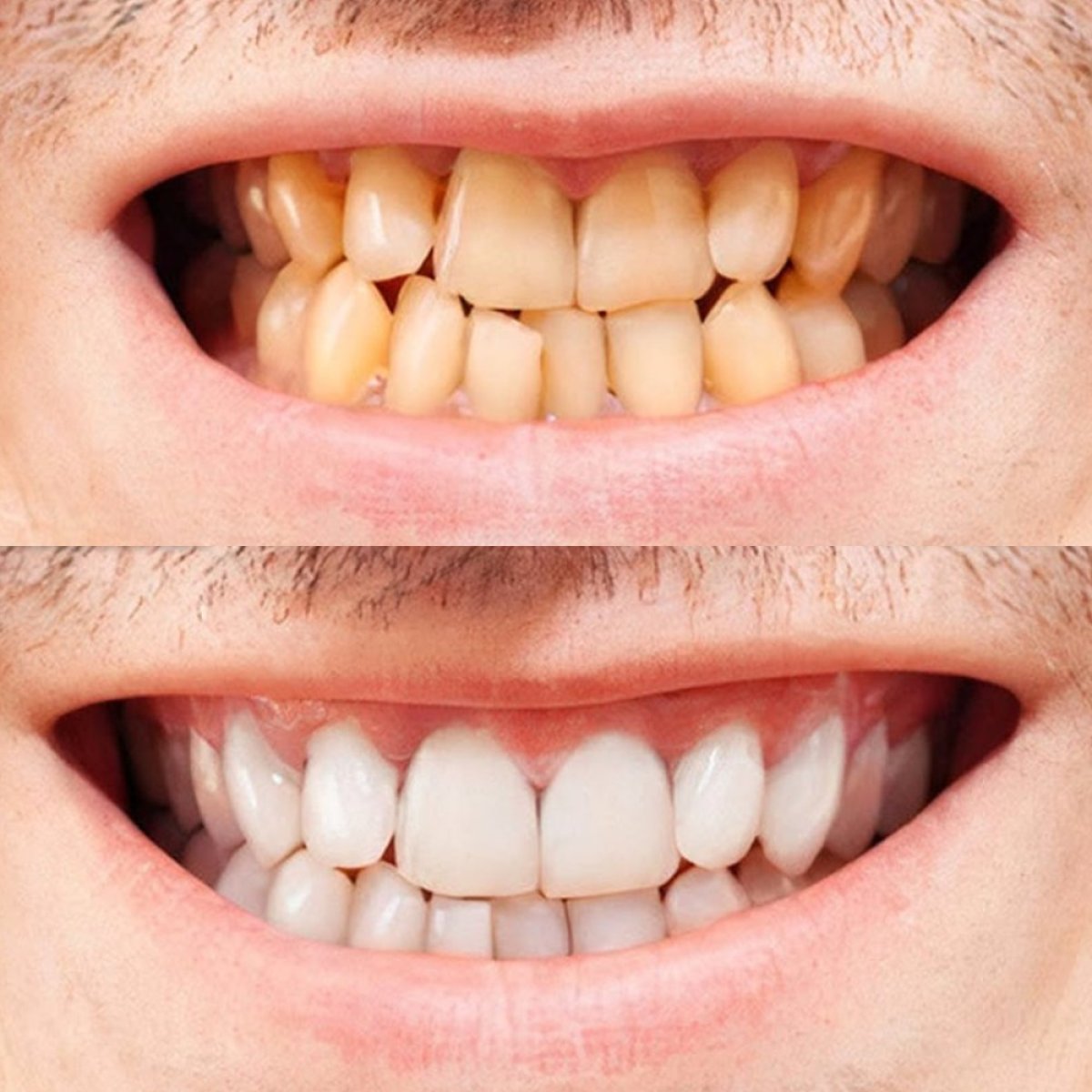 Resultados de blanqueamiento dental antes y después en dr. Vladau Studio – sonrisa brillante