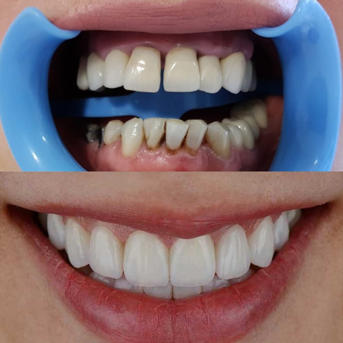 Antes y después de carillas dentales en dr. Vladau Studio – sonrisa natural y renovada