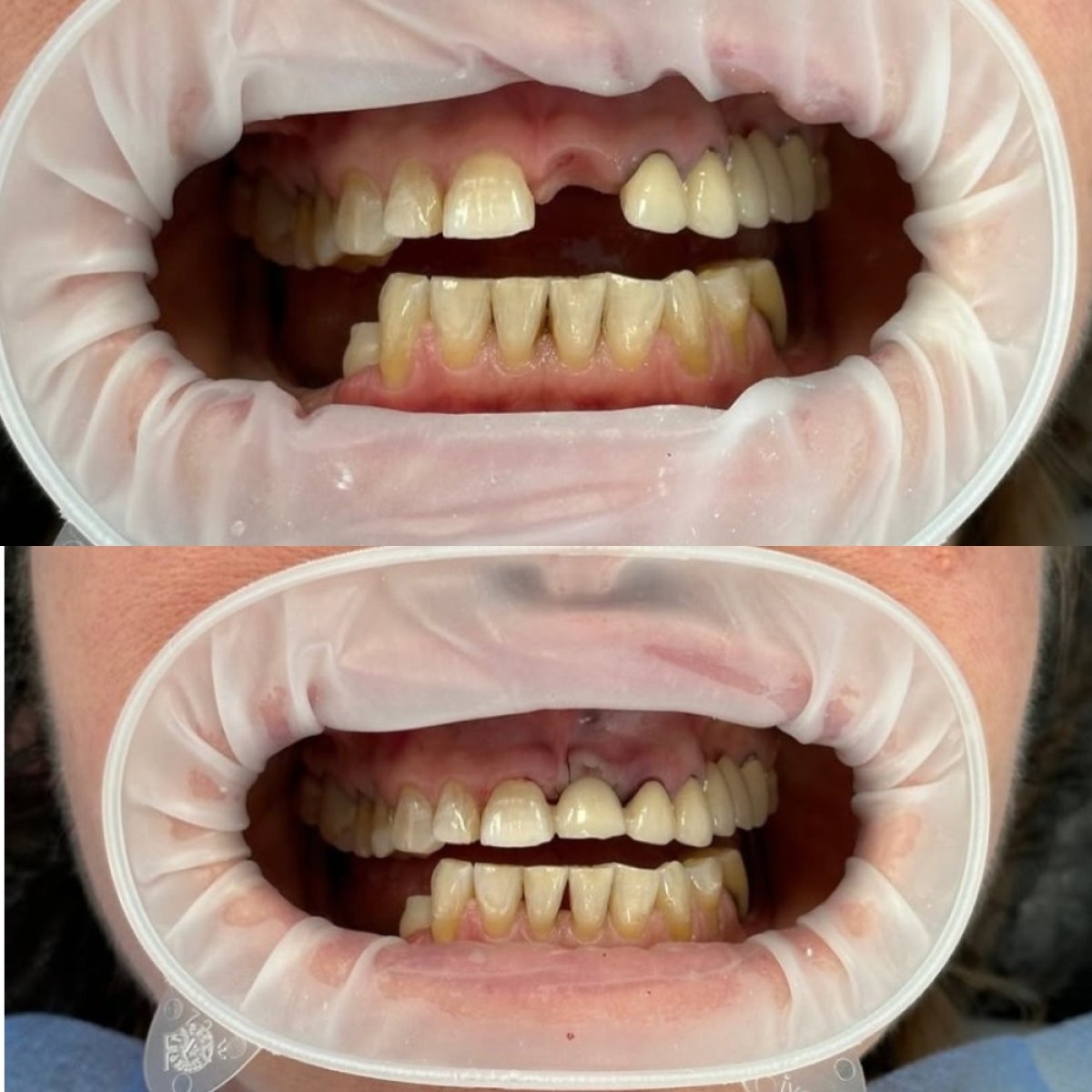 Resultados antes y después de implantes dentales en Стоматологічна клініка Axilar, sonrisa mejorada