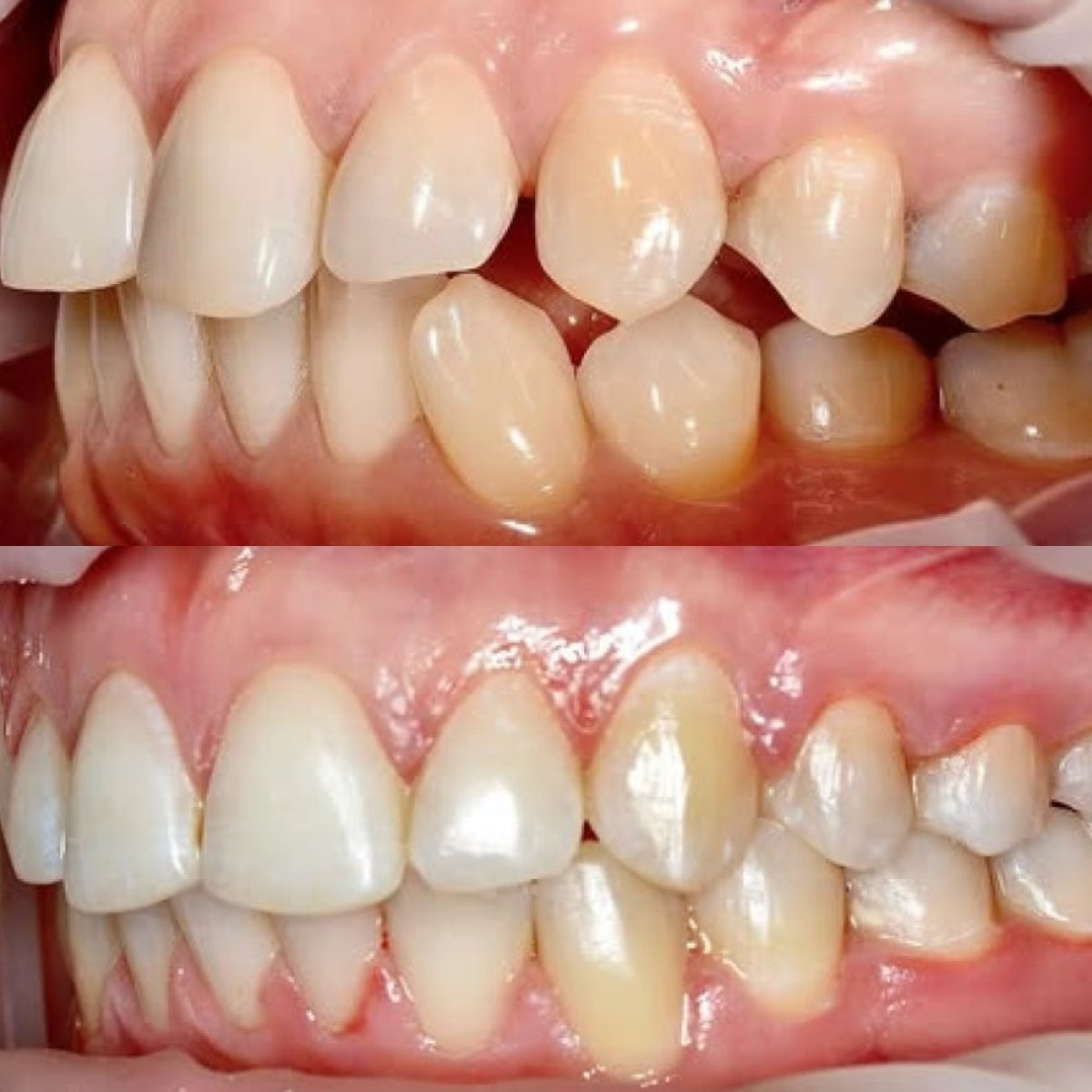 Resultados antes y después de Invisalign en Стоматологічна клініка Axilar, mejora de alineación dental