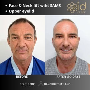 before-after photo deep-plane-facelift