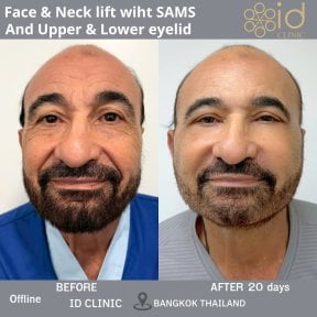 before-after photo deep-plane-facelift