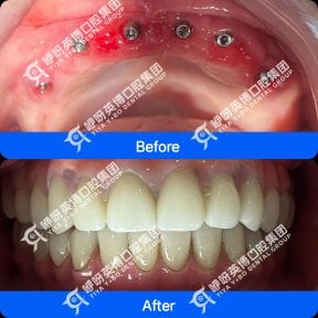 before-after photo immediate-all-on-4-dental-implants