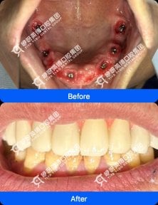 before-after photo immediate-all-on-4-dental-implants