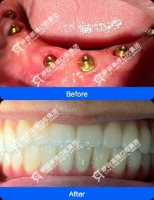 before-after photo immediate-all-on-4-dental-implants