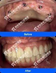 before-after photo immediate-all-on-4-dental-implants