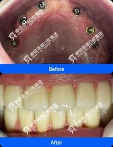 before-after photo immediate-all-on-4-dental-implants