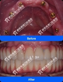 before-after photo immediate-all-on-4-dental-implants