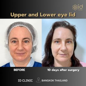 before-after photo rhinoplasty-nose-job