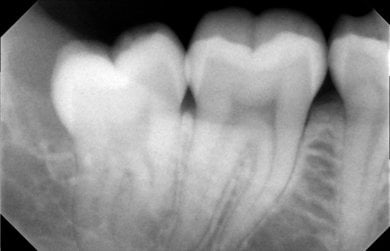 before-after photo wisdom-tooth-removal