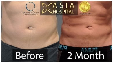 Gynecomastia surgery before and after results at Asia Cosmetic Hospital, 2 months post-op