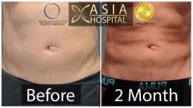 Gynecomastia surgery before and after results at Asia Cosmetic Hospital, 2 months post-op