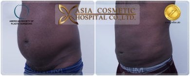 Gynecomastia surgery before and after results at Asia Cosmetic Hospital, flatter chest contour