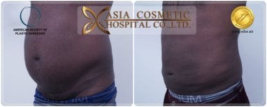 Gynecomastia surgery before and after results at Asia Cosmetic Hospital, flatter chest contour