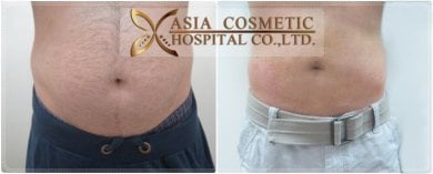 Gynecomastia surgery before and after results at Asia Cosmetic Hospital, flatter male chest
