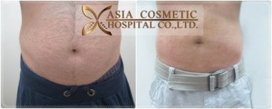 Gynecomastia surgery before and after results at Asia Cosmetic Hospital, flatter male chest