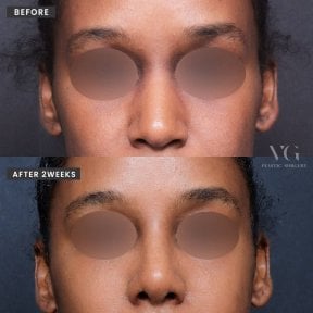 Vorher-nachher-Ergebnis Osteotomie-Rhinoplastik bei VG Plastic Surgery, verbesserte Nasenform
