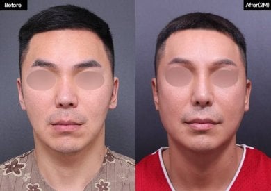 Vorher-nachher-Ergebnis Osteotomie-Rhinoplastik bei VG Plastic Surgery, verbesserte Nasenform