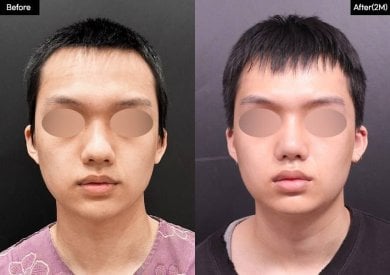 Vorher-nachher-Ergebnisse der Osteotomie-Rhinoplastik bei VG Plastic Surgery, verbesserte Nase