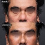 Osteotomy rhinoplasty before and after results at VG Plastic Surgery, improved nose shape