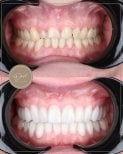قبل وبعد قشور الأسنان في عيادة D'art Dental Clinic – ابتسامة محسنة وأسنان أكثر بياضًا