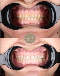 نتائج قبل وبعد الفينير في عيادة D'art Dental Clinic – ابتسامة محسنة وأسنان أكثر بياضًا