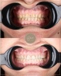نتائج قبل وبعد الفينير في عيادة D'art Dental Clinic – ابتسامة محسنة وأسنان أكثر بياضًا