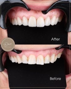 نتائج قبل وبعد الفينير في عيادة D'art Dental Clinic – تحسين جمالية الابتسامة
