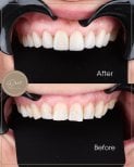 نتائج قبل وبعد الفينير في عيادة D'art Dental Clinic – تحسين جمالية الابتسامة