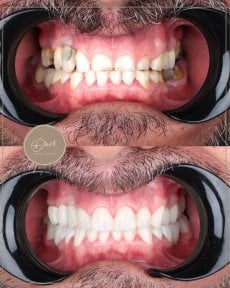 نتائج قبل وبعد الفينير في عيادة D'art Dental Clinic – ابتسامة طبيعية وجذابة
