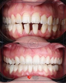 نتائج قبل وبعد تقويم Invisalign في عيادة D'art Dental Clinic – تحسين انتظام الأسنان والابتسامة