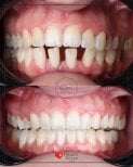 نتائج قبل وبعد تقويم Invisalign في عيادة D'art Dental Clinic – تحسين انتظام الأسنان والابتسامة