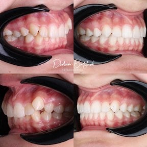 نتائج قبل وبعد تقويم Invisalign في عيادة D'art Dental Clinic – تحسين ترتيب الأسنان والابتسامة