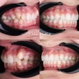 نتائج قبل وبعد تقويم Invisalign في عيادة D'art Dental Clinic – تحسين ترتيب الأسنان والابتسامة
