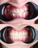 نتائج قبل وبعد تقويم Invisalign في عيادة D'art Dental Clinic – أسنان أكثر استقامة وابتسامة محسنة