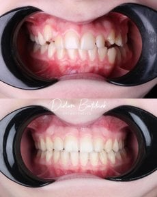 نتائج قبل وبعد تقويم Invisalign في عيادة D'art Dental – تحسين انتظام الأسنان والابتسامة
