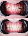 نتائج قبل وبعد تقويم Invisalign في عيادة D'art Dental – تحسين انتظام الأسنان والابتسامة