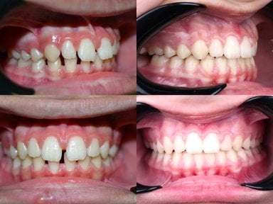 نتائج قبل وبعد تقويم Invisalign في عيادة D'art Dental Clinic – أسنان أكثر استقامة وابتسامة محسنة