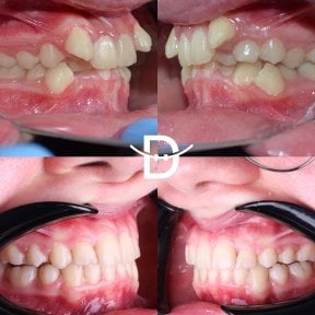 نتائج قبل وبعد تقويم Invisalign في عيادة D'art Dental Clinic – تحسين انتظام الأسنان والابتسامة