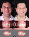 نتائج قبل وبعد تقويم Invisalign في عيادة D'art Dental Clinic – تحسين ترتيب الأسنان والابتسامة