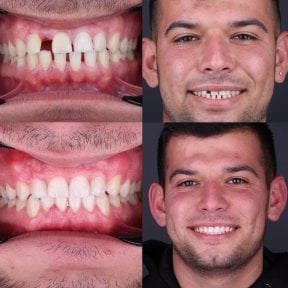 نتائج قبل وبعد تقويم Invisalign في عيادة D'art Dental Clinic – تحسين ترتيب الأسنان والابتسامة