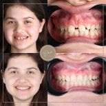 نتائج قبل وبعد تقويم Invisalign في عيادة D'art Dental Clinic – تحسين ترتيب الأسنان والابتسامة