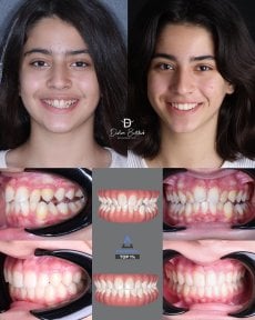 نتائج قبل وبعد تقويم Invisalign في عيادة D'art Dental Clinic – تحسين انتظام الأسنان والابتسامة