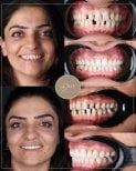 نتائج قبل وبعد تقويم Invisalign في عيادة D'art Dental Clinic – تحسين ترتيب الأسنان والابتسامة