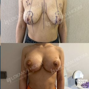 Resultados antes y después de reducción de senos en Lokman Hekim Istanbul Hospital, mejor contorno