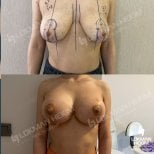 Resultados antes y después de reducción de senos en Lokman Hekim Istanbul Hospital, mejor contorno