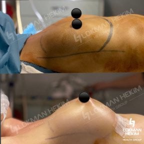 Resultados antes y después de reducción de senos en Lokman Hekim Istanbul Hospital, mejor contorno