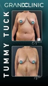 Resultados de abdominoplastia antes y después en Grand Clinic – mejora del contorno abdominal