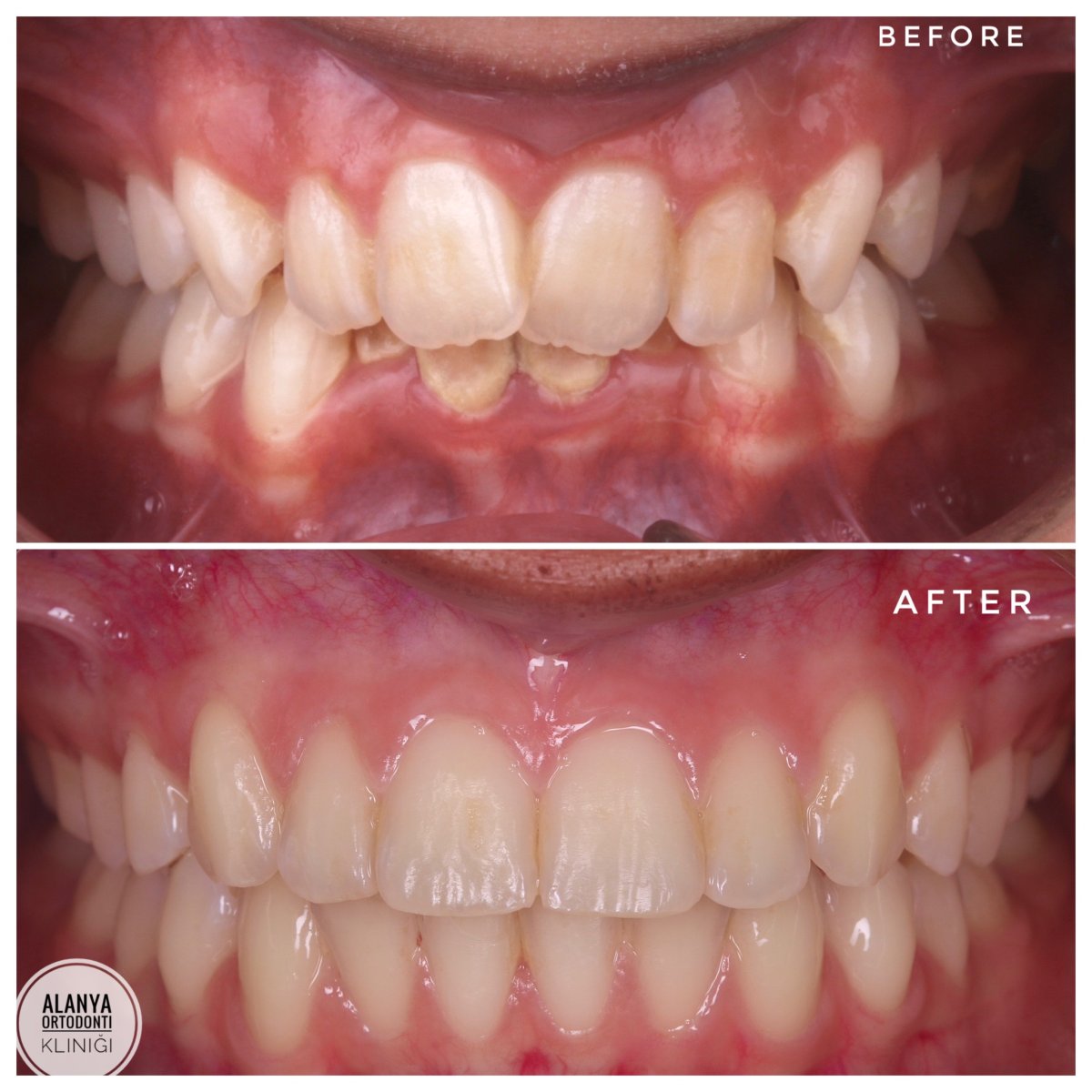 Resultado antes y después de brackets en Alanya Ortodonti Klinigi – alineación dental