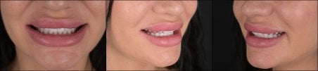 Преображение улыбки с винирами в RIKOTA Dental Clinic – естественный результат